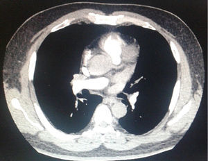 Tomografía axial computarizada con reconstrucción de vasos coronarios, se muestra origen común de arteria coronaria con trayecto interarterial.