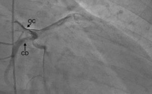Arteriografía coronaria, se muestra origen común de arteria coronaria con trayecto interarterial. OC: origen común; CD: coronaria derecha.