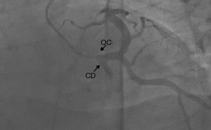 Arteriografía coronaria, se muestra origen común de arteria coronaria con trayecto interarterial. OC: origen común; CD: coronaria derecha.