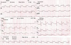 EKG del ingreso.