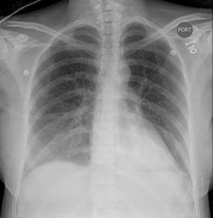 Radiografía del tórax. Proyección anteroposterior que muestra opacidades de la ocupación alveolar bilateral con incremento de la vasculatura pulmonar sugestiva del edema pulmonar.