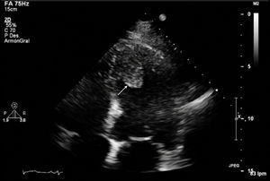 Ecocardiograma transtorácico que muestra una masa de 2,2cm de ancho, por 3,5cm de largo en forma de pera, cuyo pedículo se localiza en la región posterior y medial del ápex muy sugestivo de corresponder a un mixoma ventricular.
