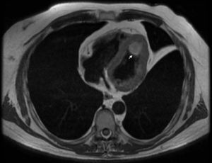 Resonancia magnética cardiaca muestra una lesión nodular intracavitaria en el ápex del ventrículo izquierdo por características y comportamiento en resonancia; considerar como primera posibilidad trombo antiguo. Menos probable el mixoma ventricular.