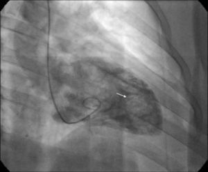 Cateterismo cardiaco: imagen con defecto de llenamiento circular, móvil y pediculada en la región apical.