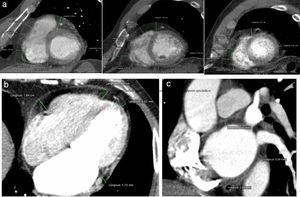 Cuantificación del tejido adiposo epicárdico: A) Proyección eje corto ventricular a nivel basal, medio y apical. B) Proyección 4 cámaras. C) Proyección eje corto auricular.