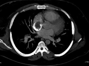 Signos de la tromboembolia pulmonar con oclusión segmentaria en el lóbulo inferior izquierdo, para los segmentos lateral y posterior.