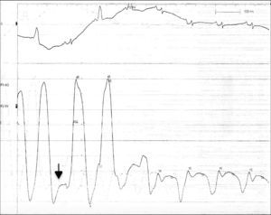 Gráfica de presiones del ventrículo derecho, en la que se observa un profundo y rápido descenso temprano en la presión ventricular en el inicio de la diástole, seguido de un aumento rápido a una meseta, llamado signo de la raíz cuadrada(flecha negra).