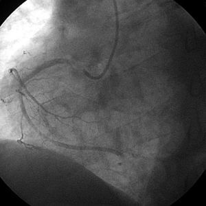Coronariografía con proyección oblicua izquierda. Defecto de repleción de contraste en el segmento proximal de la arteria coronaria derecha y en el segmento distal.