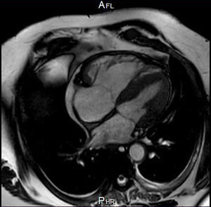 Resonancia magnética cardiaca. Imagen en plano apical 4 cámaras con un ventrículo derecho significativamente dilatado en comparación con el ventrículo izquierdo.
