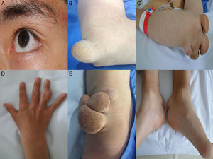 Manifestaciones cutáneas de hipercolesterolemia familiar. Ausencia de arco corneano (A), Xantomas tuberosos en codos (A y B), manos (C), rodillas (D) y tendón de Aquiles (F).