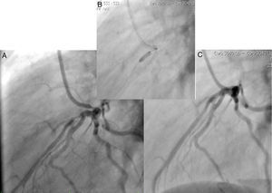Enfermedad coronaria severa en descendente anterior (A), implante de stent liberador de medicamento (B) y resultado final (C).