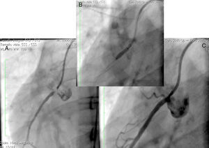 Enfermedad coronaria severa en coronaria derecha ostial (A), implante de stent liberador de medicamento (B) y resultado final (C).