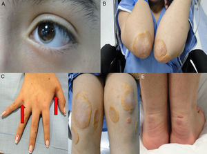Manifestaciones cutáneas de hipercolesterolemia familiar. Arco corneano inferior (A), Xantomas planos en codos (A), manos (C), rodillas (D) y tendón de Aquiles (E).
