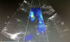Ecocardiograma realizado al gemelo bomba a las 31 semanas de gestación con evidencia de ductus arterioso cerrado.