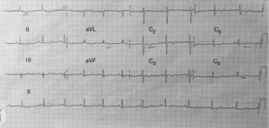 Electrocardiograma que muestra alteraciones difusas en la repolarización, lo que motivó el resto de estudios.