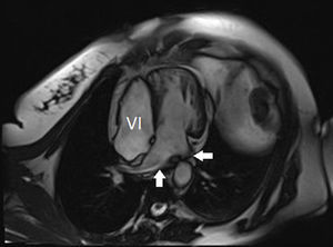Imagen axial de resonancia que permite visualizar las 4 cámaras cardiacas y sus relaciones. VI: ventrículo izquierdo. Flechas: venas pulmonares.