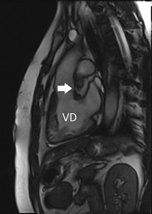 Imagen sagital de resonancia centrada en el ventrículo sistémico y sus relaciones.VD: ventrículo derecho. Flecha: infundíbulo muscular.