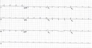 Electrocardiograma de 12 derivaciones que muestra el ritmo sinusal con frecuencia cardiaca de 95 lpm, eje normal y trastorno difuso de la repolarización. Los hallazgos principales son los bajos voltajes de forma generalizada y la ausencia del fenómeno de alternancia eléctrica.