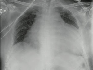 Radiografía del tórax en proyección AP con aumento marcado de la silueta cardiaca, espacios pleurales libres y sin infiltrados parenquimatosos.