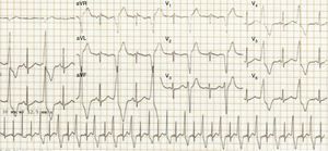 Electrocardiograma ritmo sinusal, extrasístoles ventriculares monomórficas con patrón de bloqueo de rama izquierda con transición tardía y eje inferior derecho.