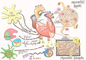 Fase aguda y subaguda de la miocarditis viral. Adaptado de Kindermann I, Barth C, Mahfoud F Ukena C, Lenski M, Yilmaz A et al. Update on myocarditis. J Am Coll Cardiol. 2012;59:779–92.