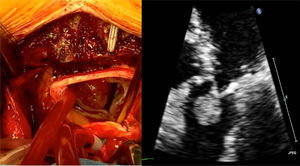 Fibroelastoma en válvula aórtica intraoperatorio y en ecocardiograma transtorácico.