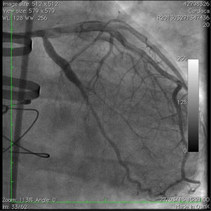 Imagen angiográfica final.