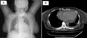 (A) Radiografía del tórax PA en la que se observa aumento marcado de la silueta cardiaca. No hay compromiso del parénquima pulmonar. No se visualiza el seno costo-diafragmático izquierdo. (B) Tomografía del tórax que registra derrame pericárdico grande circunferencial y derrame pleural bilateral pequeño.