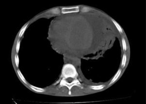 Tomografía del tórax que registra derrame pericárdico grande circunferencial y derrame pleural izquierdo pequeño.