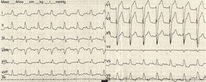 Electrocardiograma previo al bloqueo AV del paciente. Se evidenciaba bloqueo completo de rama izquierda y bloqueo AV de primer grado.