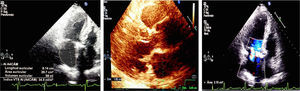 Imágenes de ecocardiografía bidimensional y Doppler en las que se evidencia dilatación moderada a severa de la aurícula izquierda: volumen auricular 58ml.