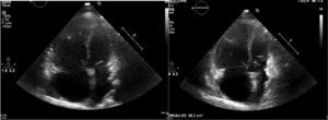Ecocardiograma que sugiere hipertensión pulmonar; dilatación importante de cámaras derechas. VD: ventrículo derecho.