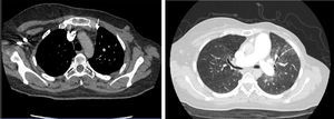 Defectos de perfusión encontrados en la angiotomografía de tórax. a) Banda dentro de una arteria pulmonar. b) Patrón en mosaico.