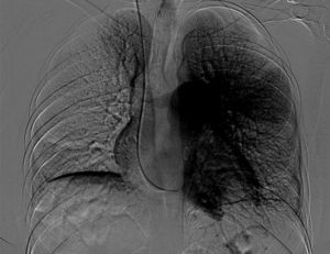 Imagen de angiografía pulmonar en la hipertensión pulmonar tromboembólica crónica.