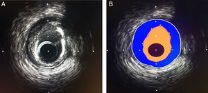 A. Representación imagenológica de la pared vascular mediante IVUS, B. Representación esquemática de la pared vascular; área luminal color amarillo, intima (puntos amarillos), media representada por línea blanca, área azul corresponde a área de ateroma.