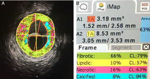 Histología virtual. A la izquierda, corte de arteria con evaluación de composición de placa. A la derecha: porcentaje de cada componente.