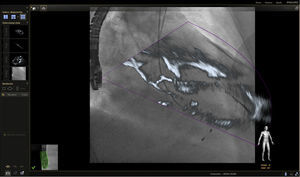 Imagen de fusión eco 3D/fluoroscopia. Se observa paso de la guía a través de la válvula aórtica, alojándose en el ventrículo izquierdo durante procedimiento de TAVI.