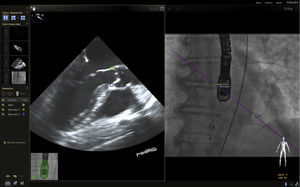 Imagen de fusión. Procedimiento de colocación de prótesis aórtica por vía percutánea (TAVI). Colocación de marcadores de aorta y válvula mitral.