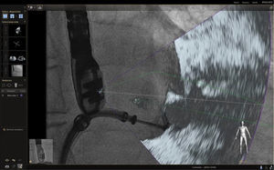 Imagen de fusión. Durante la maniobra de colocación del Mitraclip se observa pérdida de registro de la sonda respecto al fluoroscopio.