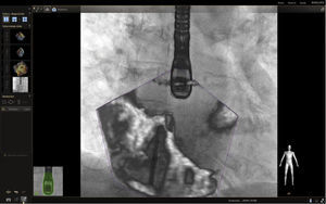 Se observa en proyección bicava por ecocardiografía transesofágica 3D el marcador en la pantalla de fluoroscopio como guía en el momento previo a la punción del septo interauricular.