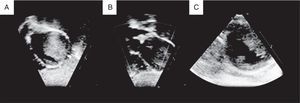 Two-dimensional echocardiogram in a 2-year-old child with a large left ventricular fibroma. A. Subcostal sagittal sweeps showing homogenous intramural mass extending from the left ventricular free wall into the cavity. B. Subcostal coronal sweeps revealing no left ventricular outﬂow obstruction. C. Parasternal short-axis shows tumor involving the anterior papillary muscle.
