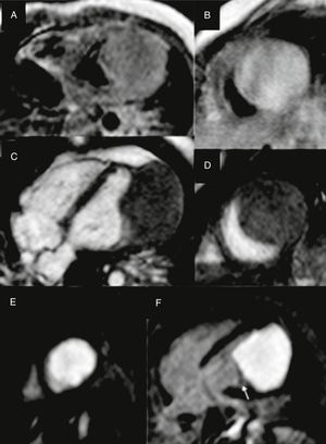 Cardiac magnetic resonance imaging. A. Aaxial T1-weighted spin- echo image; B. DP-weighted spin -echo image; C. 4 chamber view gradient-echo cine; D. Short axis gradient-echo cine. An isointense solid mass is observed in T1, slightly hyperintense relative to muscle on T2 and gradient-echo sequences, located in left ventricular lateral wall. E, F. Late contrast-enhanced cardiac magnetic resonance images after gadolinium injection in short axis (E) and four chamber view (F), showing a homogeneous mass. Lateral wall and apex myocardium can be appreciated, closely to the mass on its lateral, top and bottom margins and papillary muscle (arrow).