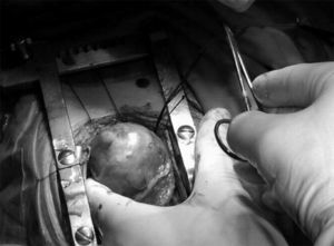 Intraoperative view: large mass protruding from the left ventricular apex.