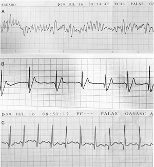 Trazados electrocardiográficos durante el episodio de muerte súbita por cardiotoxicidad aguda por doxorrubicina. A: Fibrilación ventricular. B. Posterior a la cardioversión eléctrica aparece el ritmo sinusal a 75 lpm y QRS ancho. C: Taquicardia sinusal a 140 lpm y QRS estrecho.