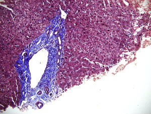 Coloración especial de tricrómico – 200X. En color azul resalta la fibrosis del espacio porta, hallazgo que puede asociarse con enfermedad de Sandhoff.