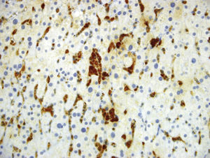 Inmunohistoquímica: CD68 – 400X. Resalta la gran cantidad de células de Kupffer en medio de los sinusoides, algunas de gran tamaño con vacuolas de grasa.