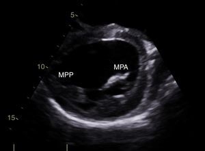 Imagen obtenida mediante ecocardiograma transtorácico. Vista paraesternal eje corto. MPA: músculo papilar anterolateral hipoplásico. MPP: músculo papilar posteromedial.