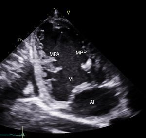 Imagen obtenida mediante ecocardiograma transtorácico. Vista apical dos cámaras. MPA: músculo papilar anterolateral hipoplásico. MPP: músculo papilar posteromedial. VI: ventrículo izquierdo. AI: aurícula izquierda.