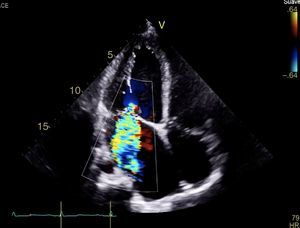 Insuficiencia mitral severa con doble mecanismo: el primero por la asimetría generada por el músculo papilar anterolateral hipotrófico y el segundo, insuficiencia mitral funcional por la dilatación de cavidades izquierdas, producto de la cardiopatía isquémica asociada al síndrome de ALCAPA.