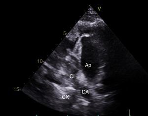 Imagen obtenida mediante ecocardiograma transtorácico. Eje corto de la arteria pulmonar. AP: arteria pulmonar. CI: arteria coronaria izquierda. DA: arteria descendente anterior. CX: arteria circunfleja.